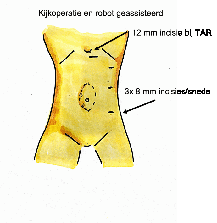 Kijkoperatie littekenbreuk