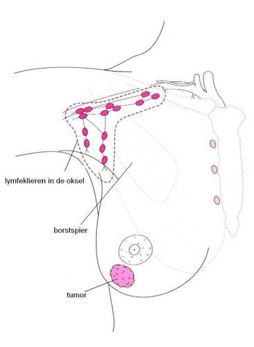 lymfeklieren in de oksel