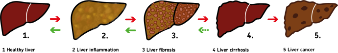 Fatty liver