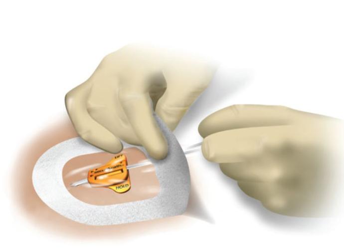verzorging nefrostomiekatheter